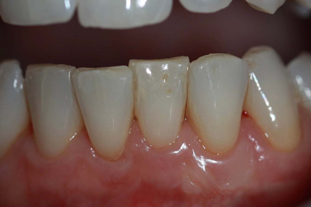 casestudy-parodontite2