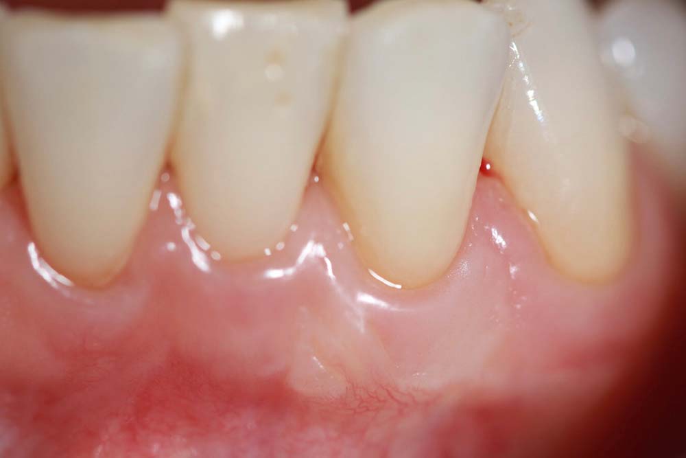 casestudy-parodontite3