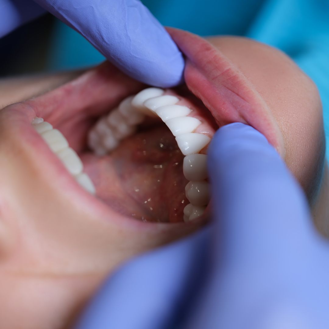 faccette dentali