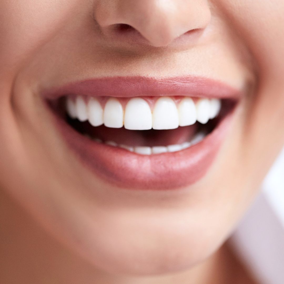 Denti perfetti con faccette dentali, donna che sorride
