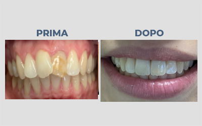 Caso Faccetta Dentale e Corona